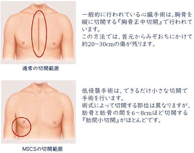 MICS