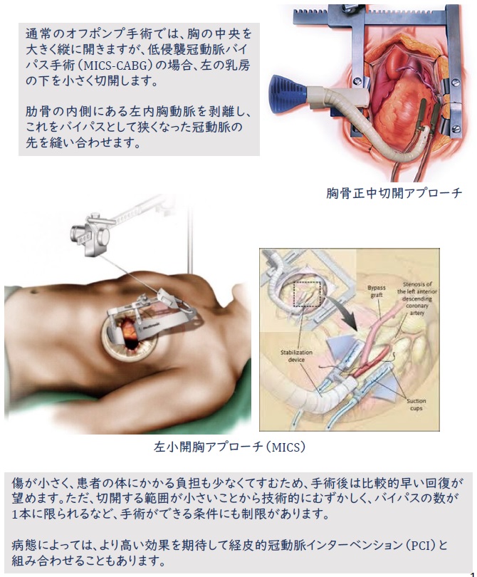 オフポンプ手術