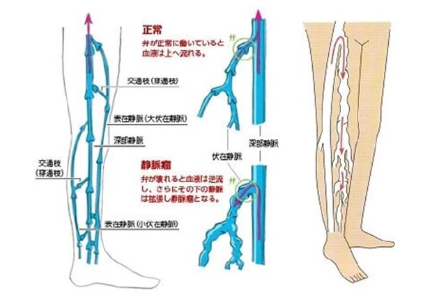 下肢静脈瘤