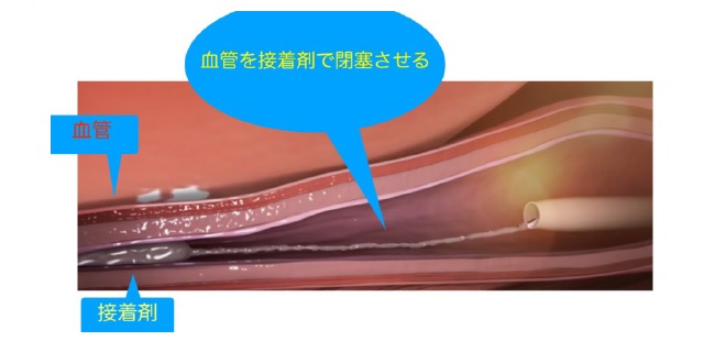血管を接着剤で塞栓させる