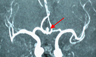 写真（前大脳動脈動脈瘤）