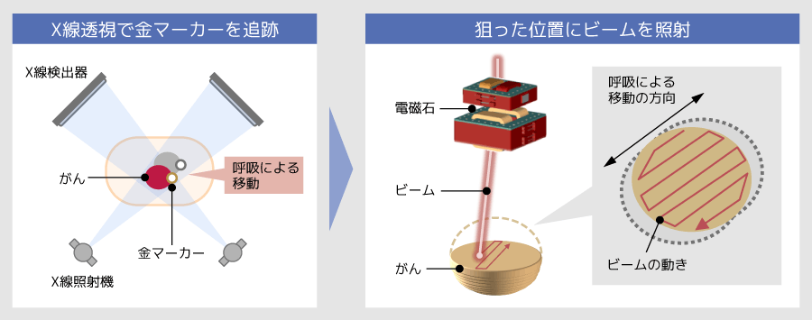 動体追跡技術を使って動くがんに陽子線を照射する仕組みを示した図