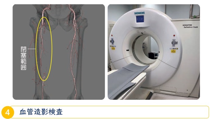 CT検査・血管造影検査
