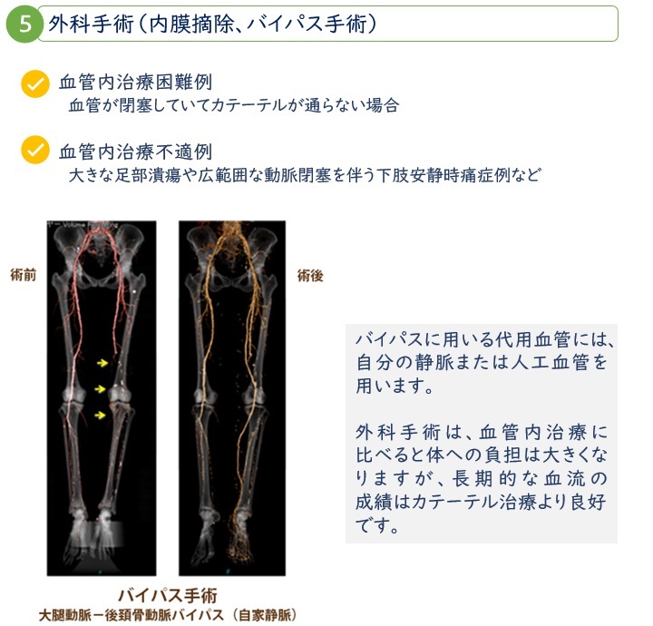 外科手術（内膜摘除、バイパス手術）