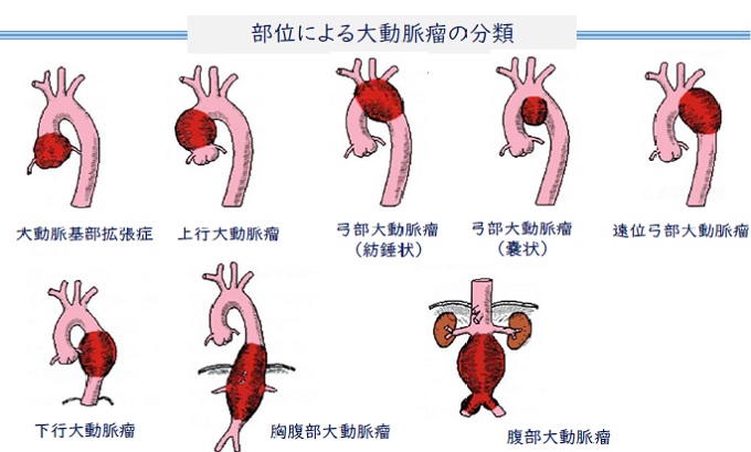 部位による大動脈瘤の分類