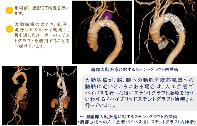 TEVAR造影CT