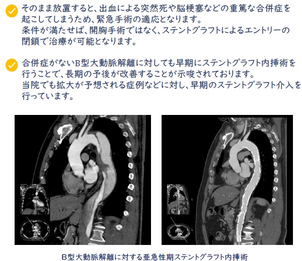 B型大動脈解離に対する亜急性期ステントグラフト内挿術