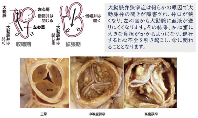 狭窄
