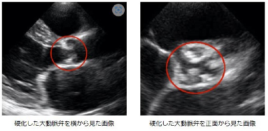 エコー画像
