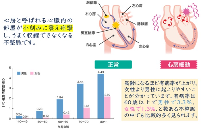 心房細動とは