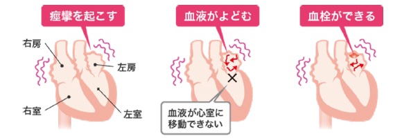心房細動の問題
