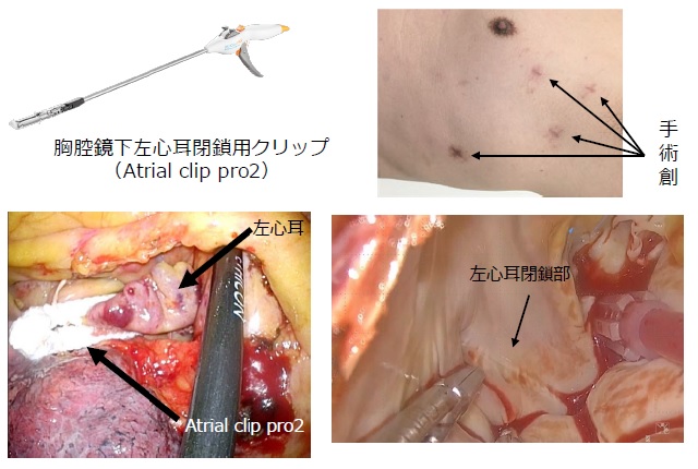 胸腔鏡下左心耳閉鎖術